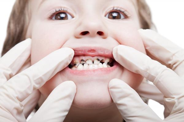 Bố mẹ phải làm gì khi bé bị sâu răng, sún răng?