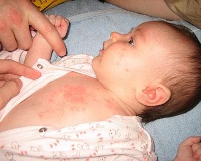 Vì sao việc chống muỗi, phòng tránh sốt xuất huyết ở trẻ nhũ nhi vô cùng cần thiết?