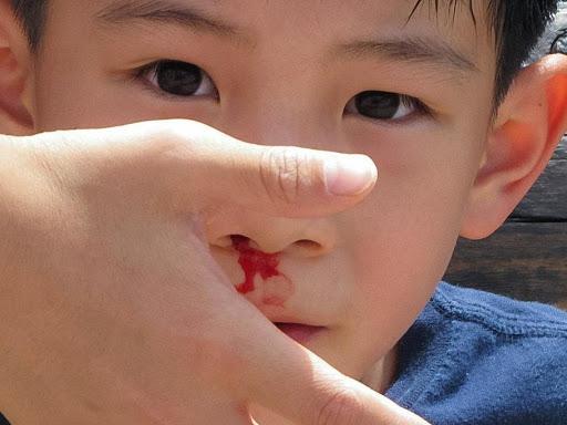 Dấu hiệu cảnh báo nguy hiểm khi trẻ nhỏ chảy máu cam