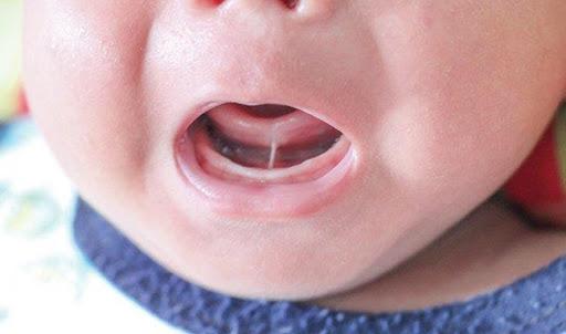 Những dấu hiệu cảnh báo cha mẹ khi trẻ bị dính dây thắng lưỡi