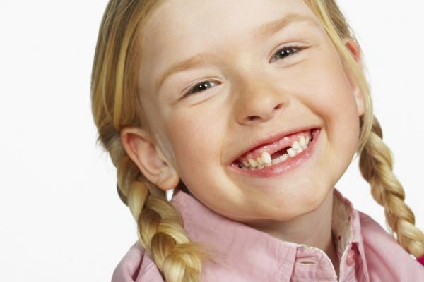 Nguyên nhân và cách phòng tránh trẻ bị sún răng sữa